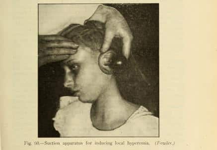 Image from a medical textbook from the 1910's. The girl pictured is not Mrs. Anna Mohr informed consent